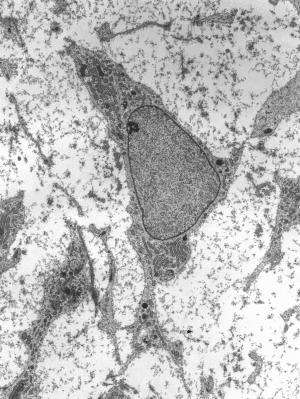 Ensaio Clínico Utilizando Células-Tronco Mesenquimais Derivadas Do Tecido Adiposo No Tratamento De Linfedema
