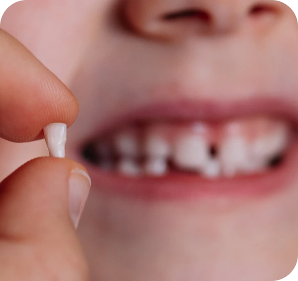 Dente de Leite